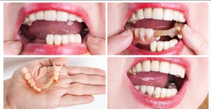 أنواع عمليات تركيب الأسنان