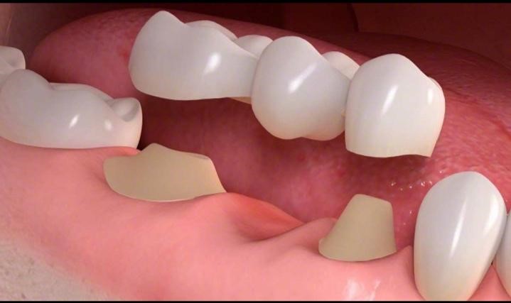 اللعومال التي تؤثر على زراعة الأسنان الفورية 