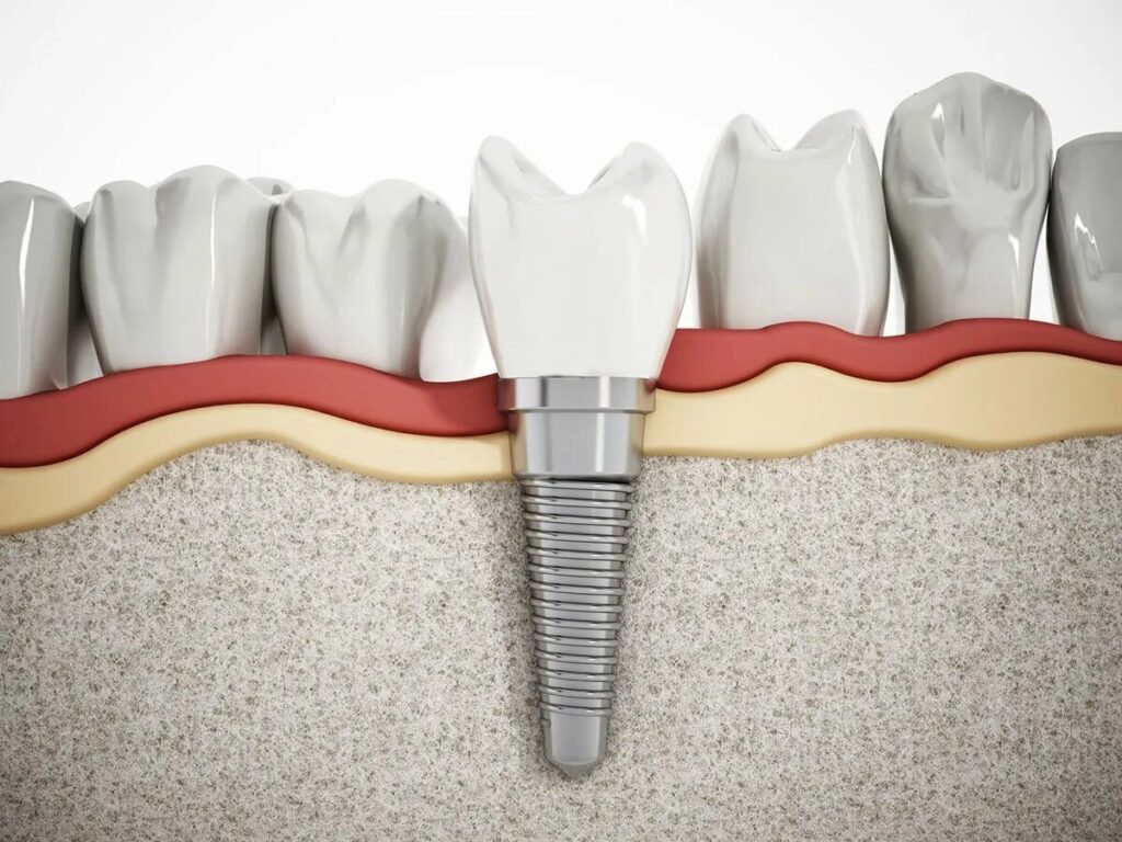 خطوات عمليات تركيبات الأسنان