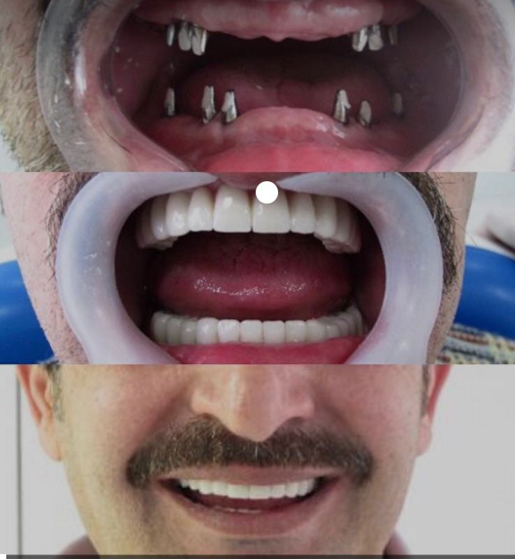 عمليات زراعة الأسنان لتعويض الأسنان المفقودة 