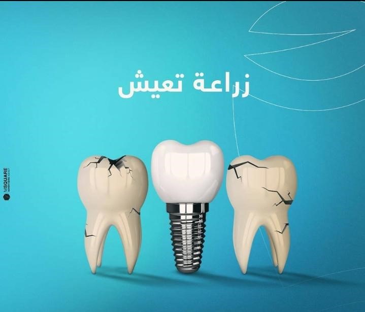  أفضل الدول في زراعة الأسنان 
هل زراعة الأسنان تدوم طوال فترة العمر
