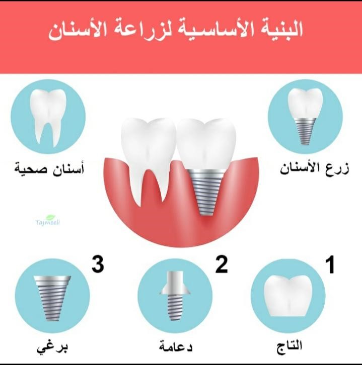  مراحل زراعة الأسنان في العيادات الطبية