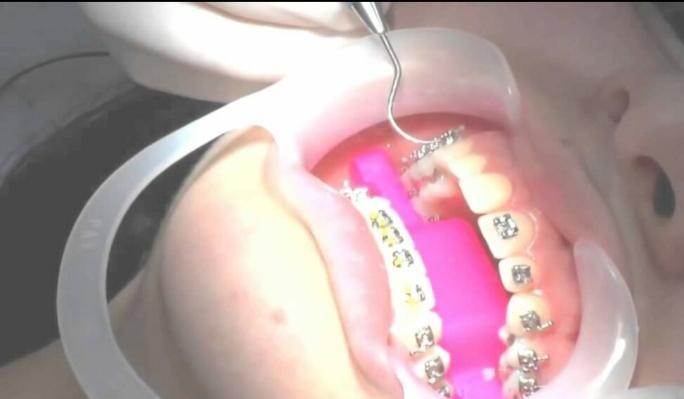 مميزات تركيب تقويم الأسنان