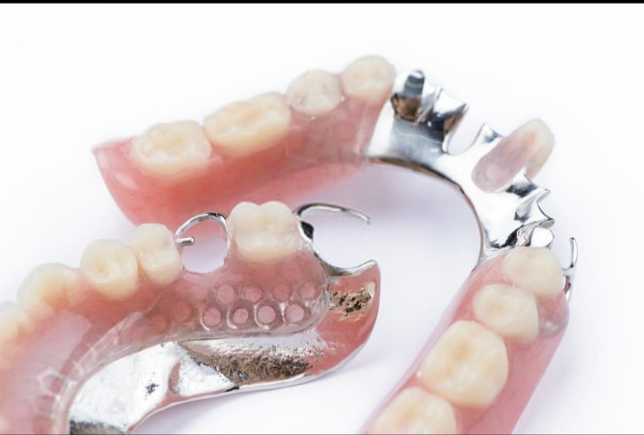 مميزات عمليات تركيب الأسنان 