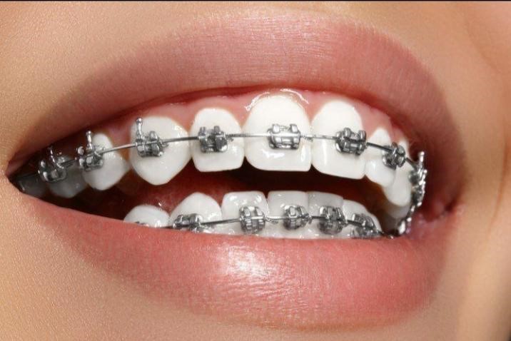 أبرز مميزات تركيب تقويم الأسنان