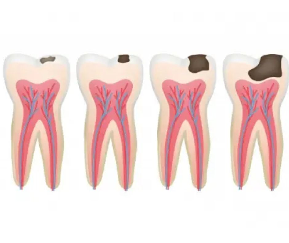 أسباب حدوث أنواع تسوس الأسنان