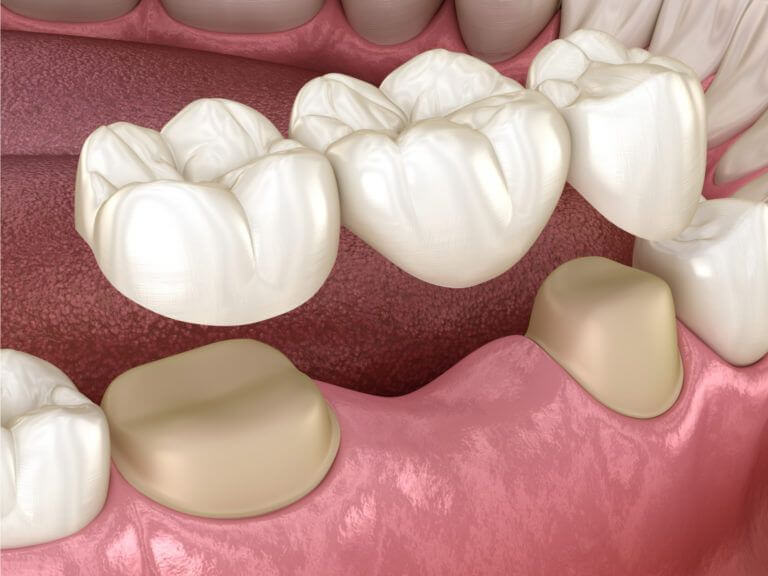 أنواع-جسر-الأسنان