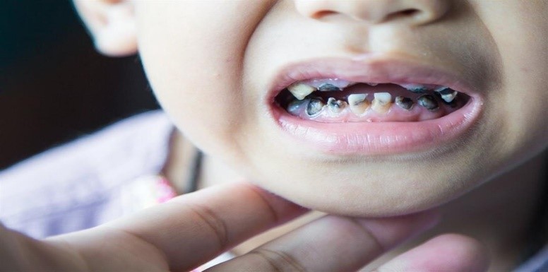 الوقاية من تسوس الأسنان عند الأطفال