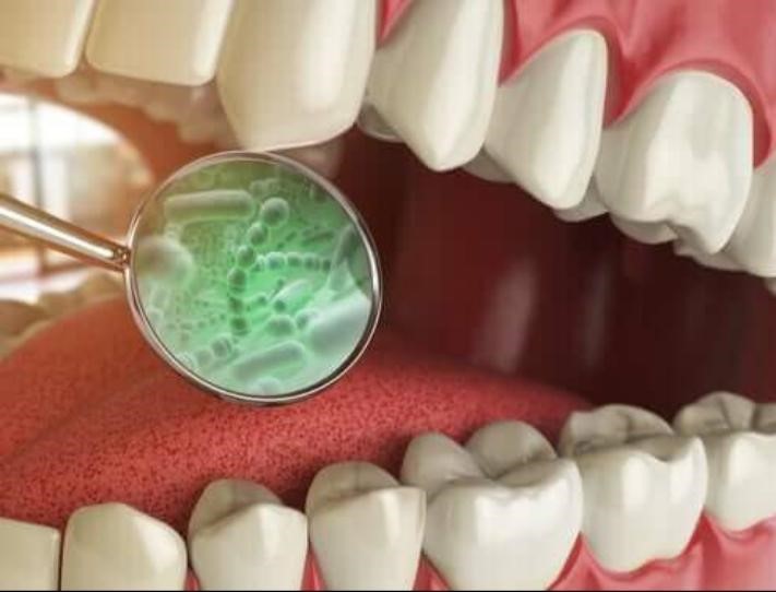 علاج أنواع بكتيريا الأسنان بالأعشاب