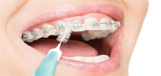 كيفية الاهتمام بتقويم الأسنان