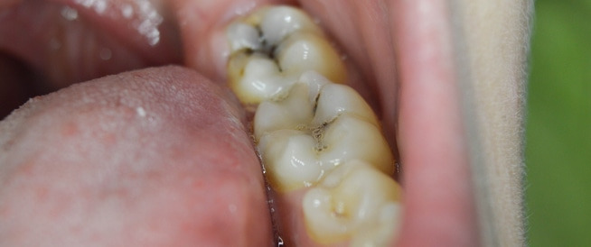 مراحل-تسوس-الأسنان