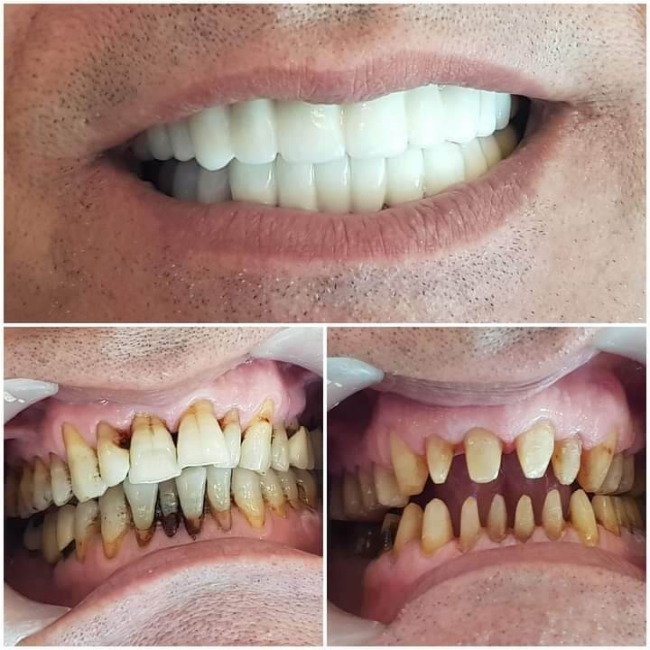 مراحل تلبيس الأسنان الأمامية بالزيركون
