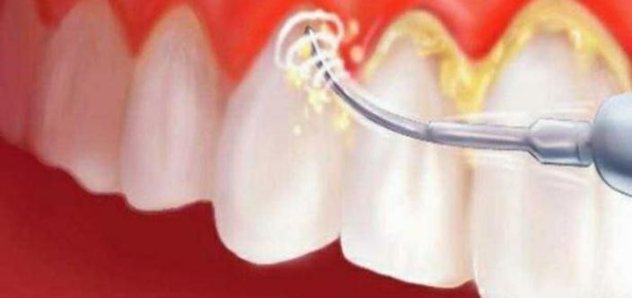 مميزات تنظيف الأسنان من الجير عند الطبيب