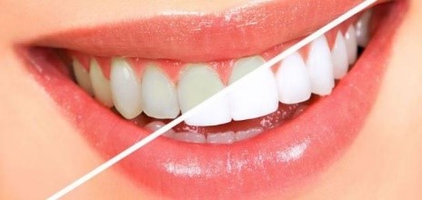 من أفضل الطرق فعالية لتبييض الأسنان