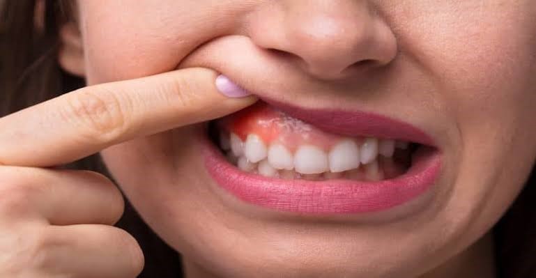 أنواع التهاب الأسنان