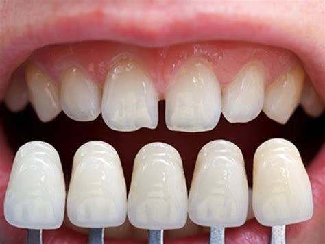 أنواع تركيب الأسنان التجميلية