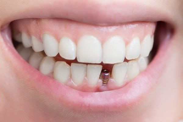 أنواع تركيبات الأسنان الصناعية