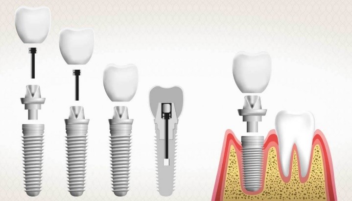 أنواع تركيبات الأسنان