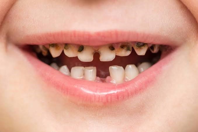 أنواع تسوس الأسنان اللبنية عند الأطفال