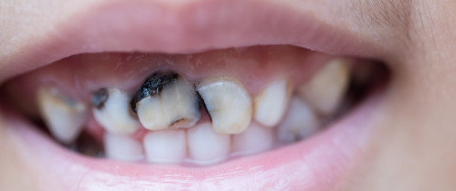 الوقاية-من-حدوث-تسوس-الأسنان-الأمامية