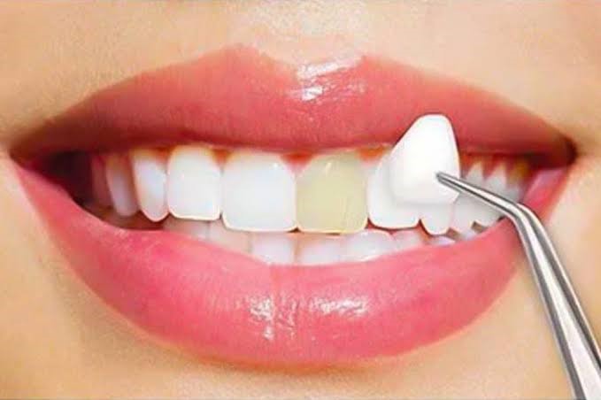 طريقة تركيب قشور الأسنان التجميلية
