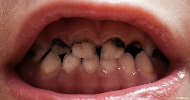 عوامل خطر الإصابة بتسوس الأسنان الأمامية
