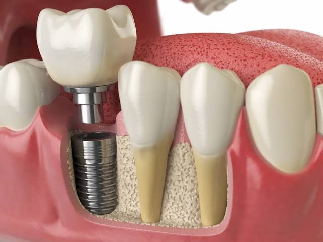 أبرز الحالات التي يناسبها بدائل زراعة الأسنان