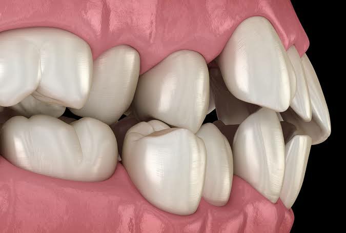 أسباب بروز الأسنان الأمامية