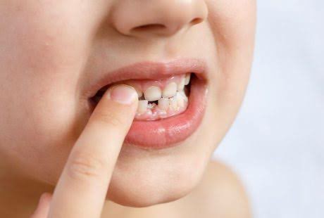 الطرق الطبيعية لعلاج تخلخل الأسنان