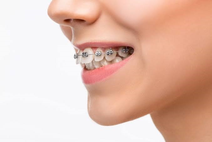 الفرق بين بروز الفك وبروز الأسنان ,علاج بروز الأسنان بالتلبيس
