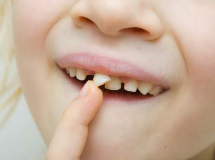 علاج تخلخل الأسنان بالعيادات الطبية