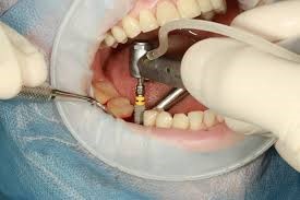 فترة استمرار الألم بعد زراعة الأسنان