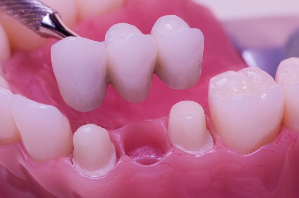 ما هي جسور الأسنان ؟